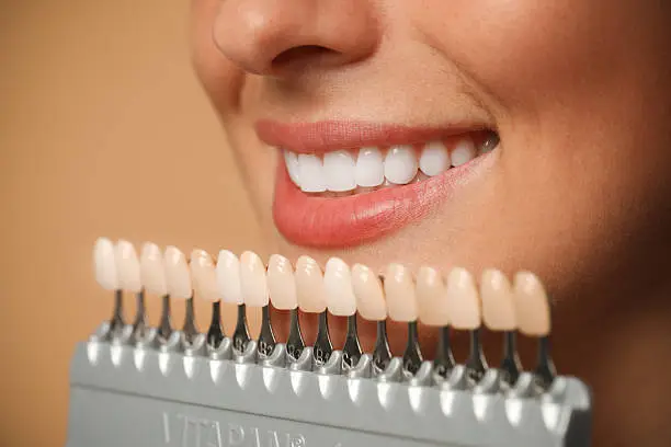 Sorriso perfetto con trattamenti di estetica dentale — Studio Dentistico Vecchiotti dr. Marco